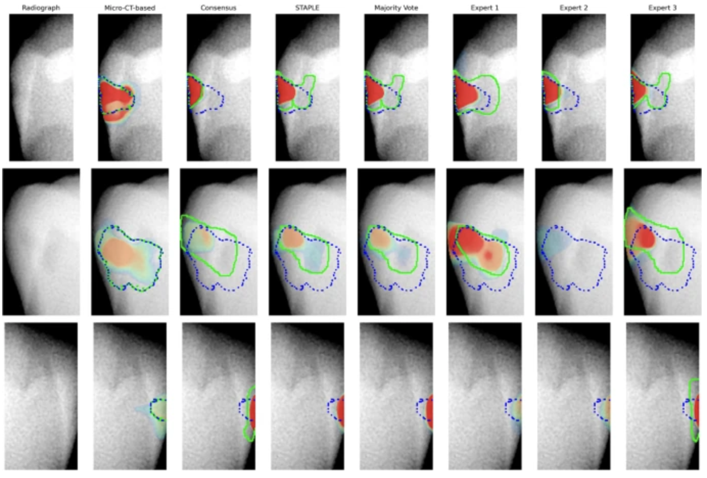 Accuracy of deep learning-based AI models for early caries lesion ...